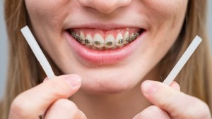Can You Eat With Wax on Your Braces?