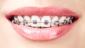 What happens if you get a cavity with braces?
