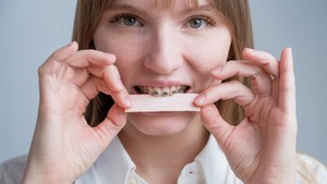 Can You Chew Gum with Braces? Everything You Need to Know