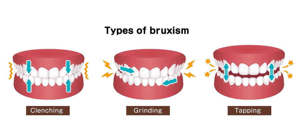 Bruxism and Braces: Understanding the Connection