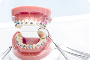 differences between metal and ceramic braces