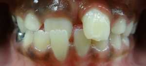 cross bite