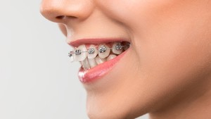 Do I Need Braces if I Have an Overbite?