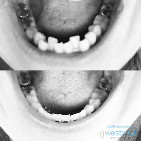 before and after smiles