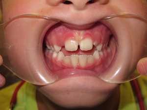 open bite