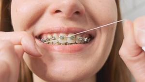 How Many Times a Day Should You Floss with Braces?