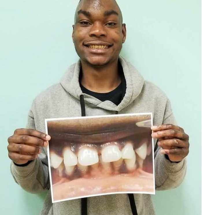 A patient named Jaylan showing off his new smile next to a picture of his smile before