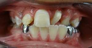 cross bite
