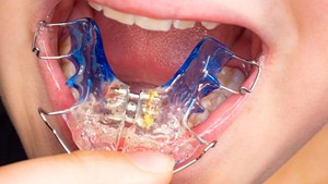 palatal expander