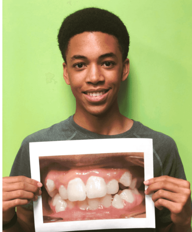 A patient named TJ showing off his new smile next to a picture of his smile before