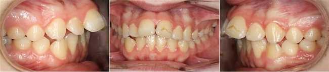 protruding teeth
