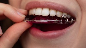 What to do if your retainer breaks and broken retainer