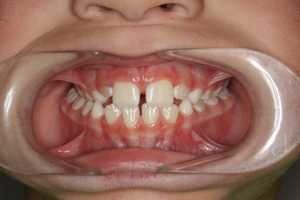 post-xbite-before