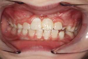 teeth after treatment