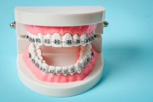 what happens if you don’t get braces