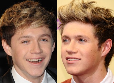 a member of the group One Direction with braces