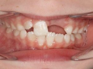 before teeth graphic