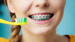 How Do You Brush Your Teeth with Braces?
