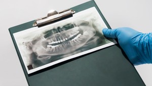 root resorption invisalign, root resorption braces, dental resorption
