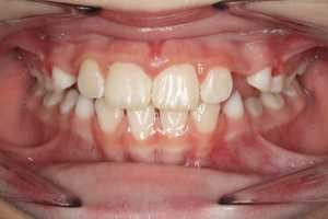 teeth that previously had crossbite