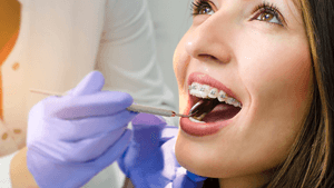 What Is Accelerated Orthodontics?