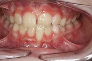 tissue damage from crossbite