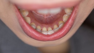 How to Fix a Broken Retainer Wire at Home