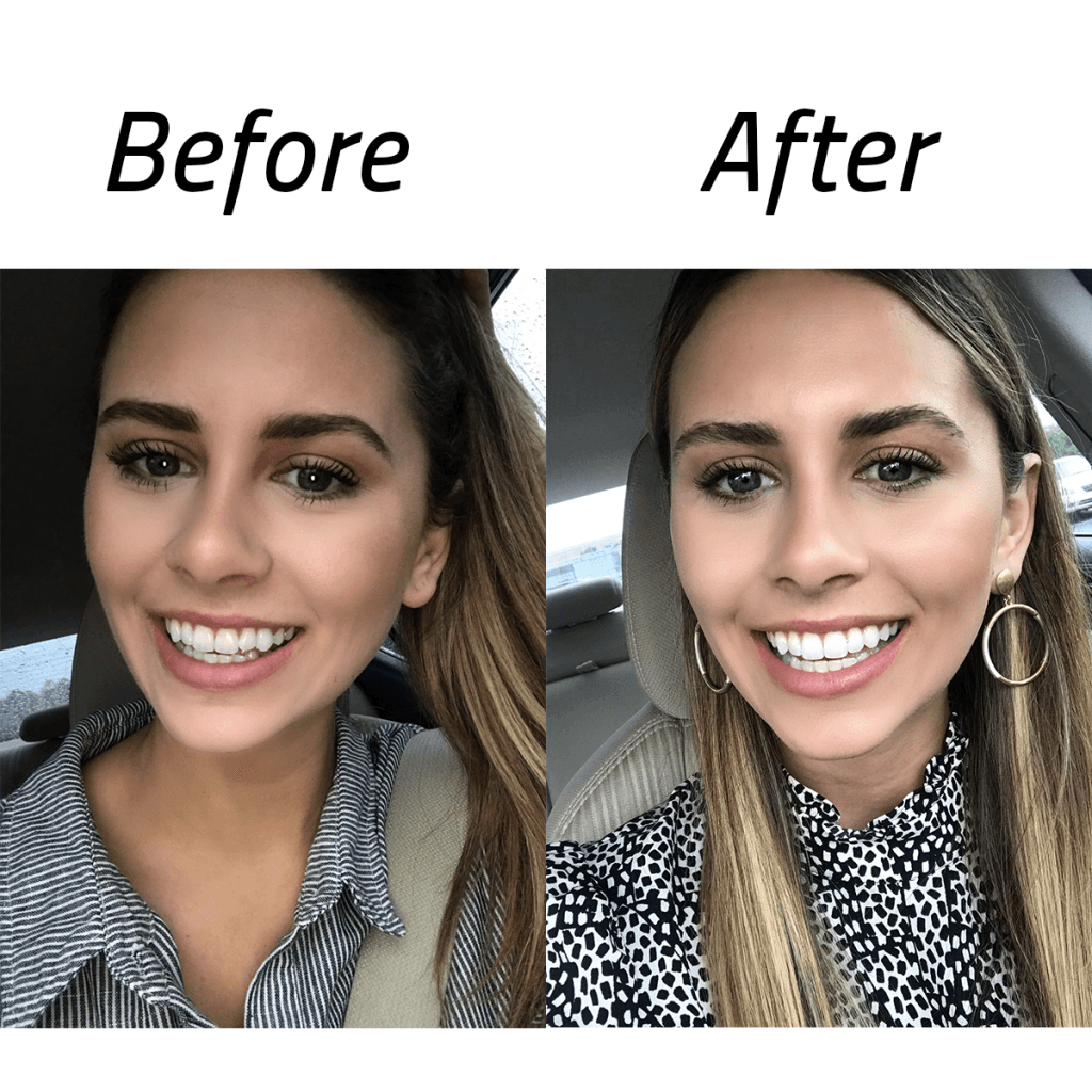 invisalign before and after
